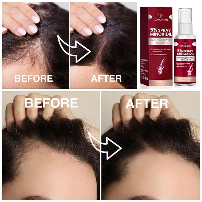 5% Minoxidil Serum for Women and Men: Hair Spray for Hair Thinning and Hair Loss to Get Thicker and Fuller Hair
