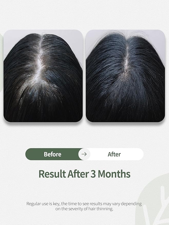 Hair Growth Serum, Women's Anti-Hair Loss Scalp Treatment, Helps with Severe Signs of Thinning, Non-Greasy, No-Rinse, Cruelty-Free, Vegan.